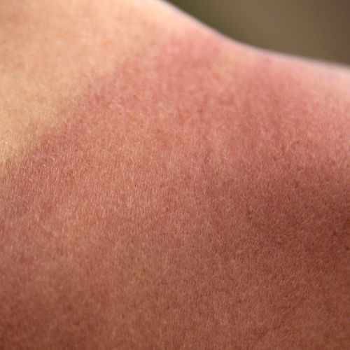 humidity caused redness on indian skin