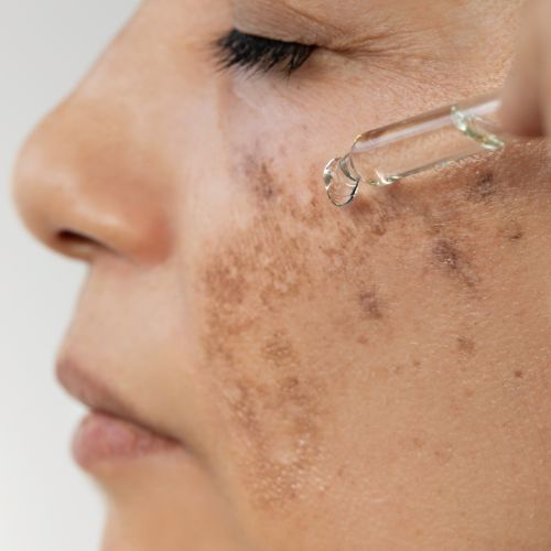 hyperpigmentation skin