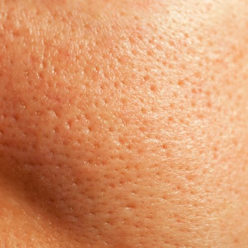 Facial skin close up showing pores